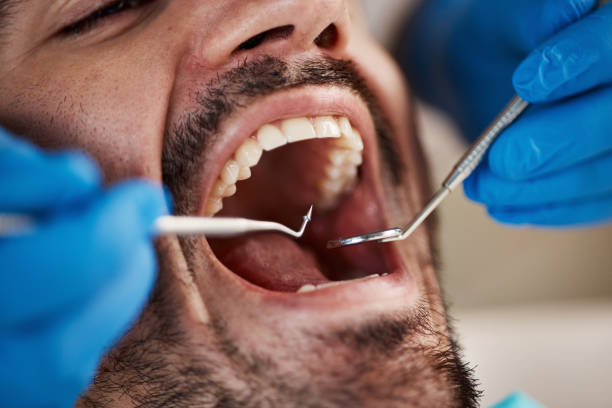 Best Emergency Tooth Extraction in Soh Salt Lake, UT